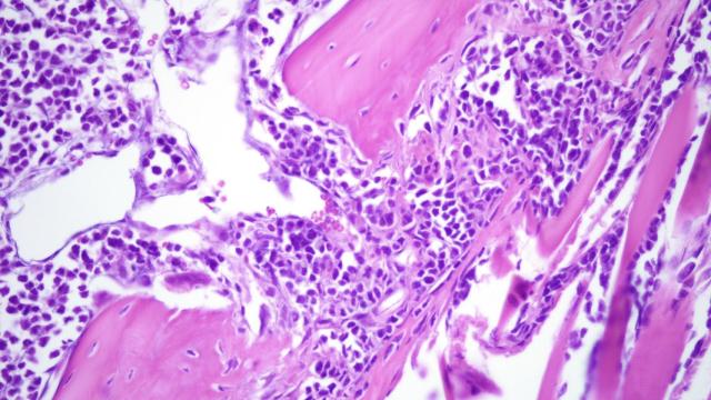 Las células cancerosas del mieloma múltiple en la médula espinal. EP.