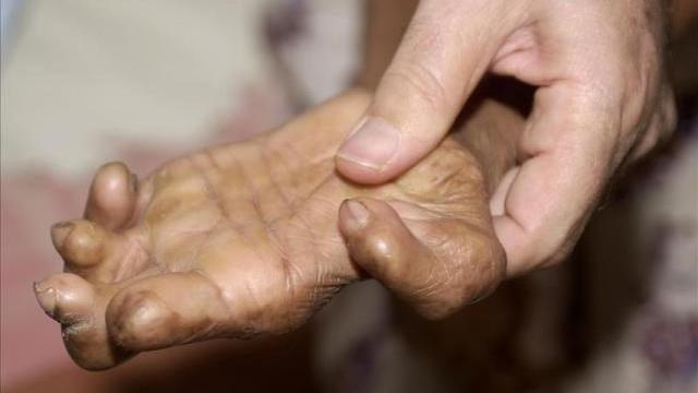 Un paciente con lepra.