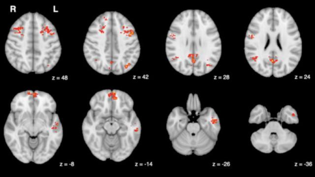 Resultados de las comparaciones a nivel de grupo ( p  < 0,05, corregido) con regiones significativas en rojo