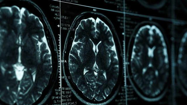 Un escáner del cerebro.