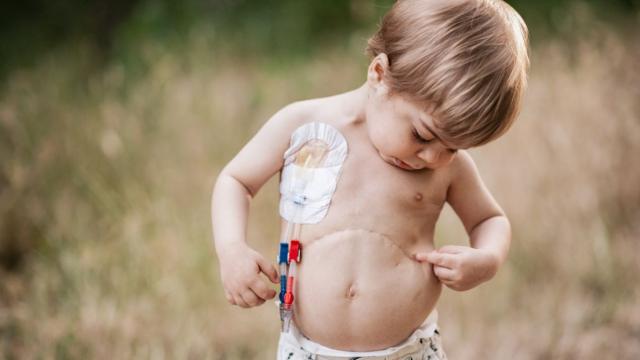 Mateo, en una imagen de @inmariosfotografia, mostrando la cicatriz del trasplante de hígado que se le realizó por la mutación del gen NEK8.