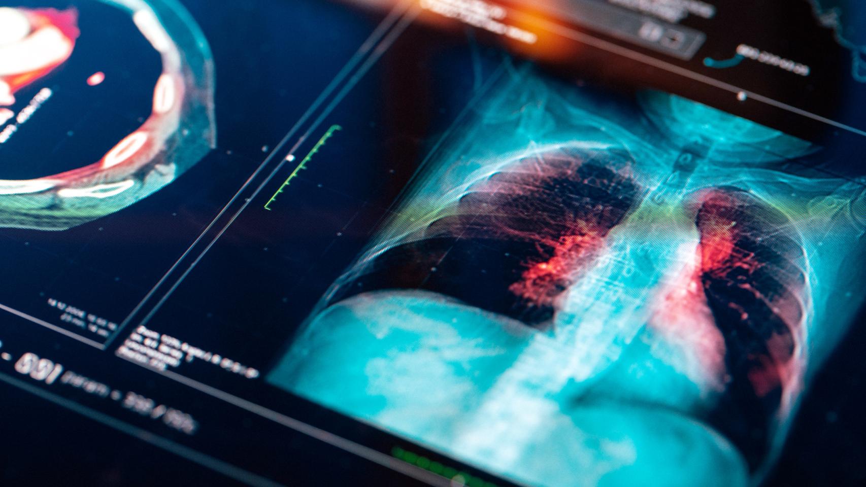 Una prueba diagnóstica por imagen es clave para localizar el cáncer de pulmón.