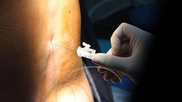 Imagen de archivo de la aplicación de la epidural en una parturienta.