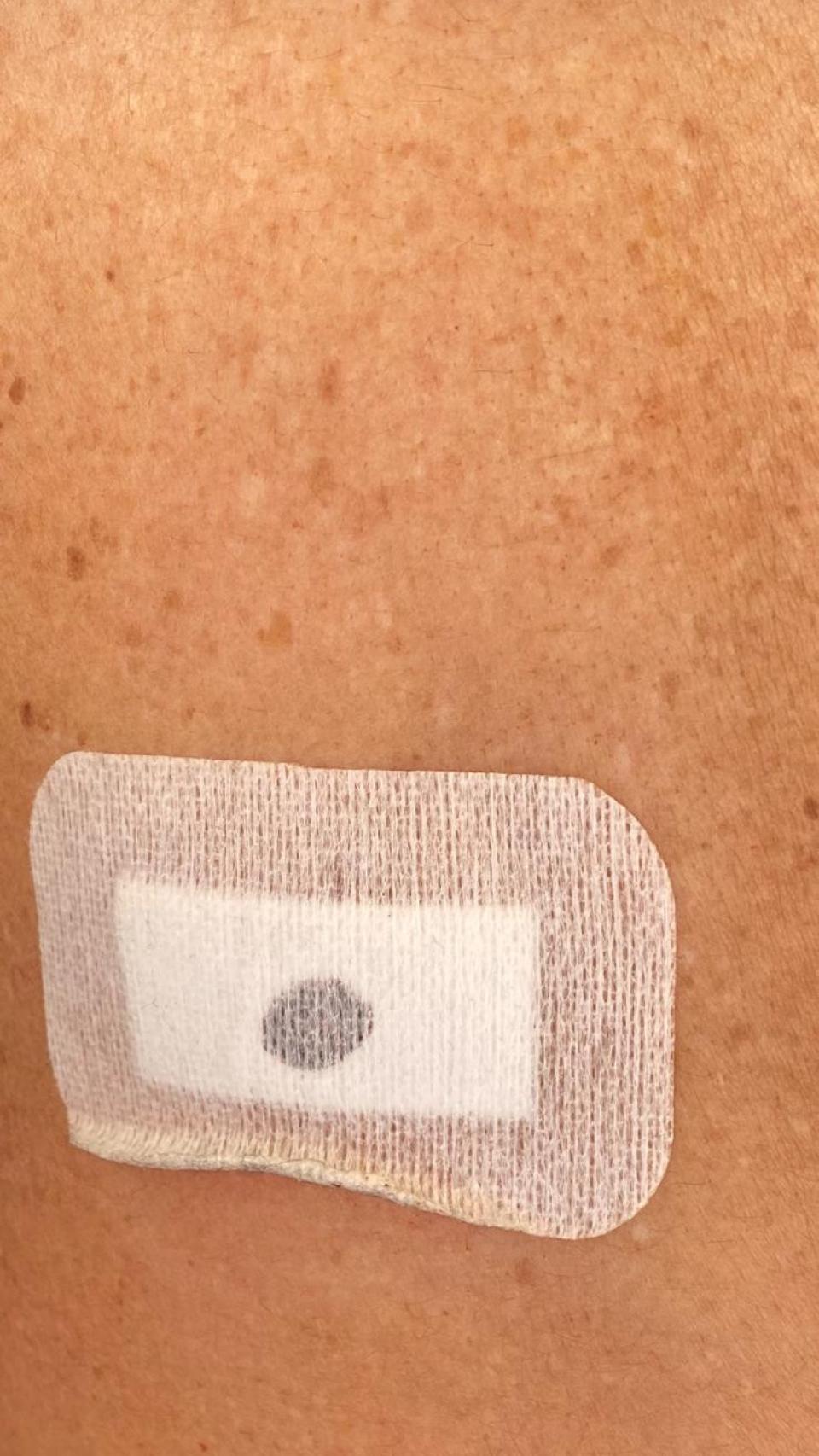 Lesión que sufrió una funcionaria de la cárcel de Campos del Río que ha tenido que ser sometida a una laparoscopia.