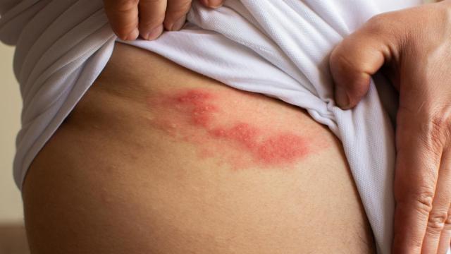 Una persona mostrando la erupción cutánea provocada por el herpes zóster.
