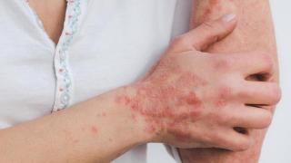 La sarna y la tiña repuntan con fuerza en pleno 2023 en Esaña: los médicos dan la voz de alarma