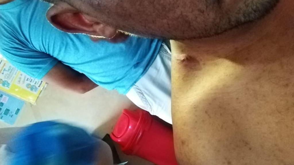 Alguna de las picaduras que Jhonatan tiene esparcidas por todo su cuerpo.