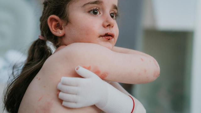 Mía tiene cinco años y fue diagnosticada con epidermólisis bullosa nada más nacer.