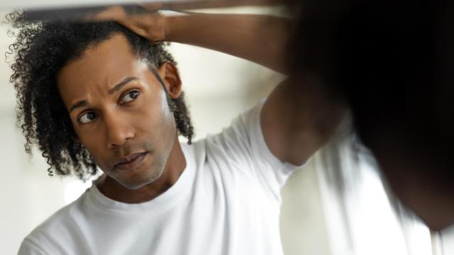 Imagen de archivo de un hombre que empieza a perder pelo.
