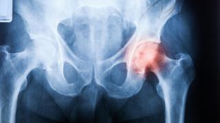 La incidencia de esta lesión en mujeres triplica a la de los hombres.