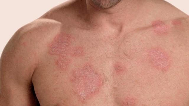 El pecho de un hombre diagnosticado de lupus.