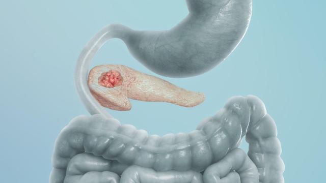 Representación del cáncer de páncreas.