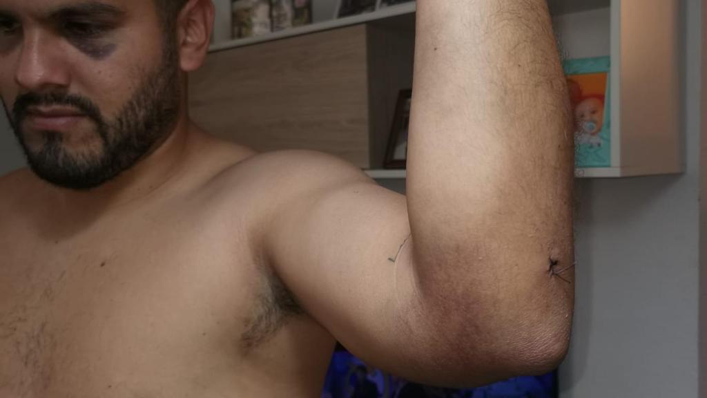 Gerson, el hijo mayor del matrimonio, mostrando moratones y puntos de sutura.