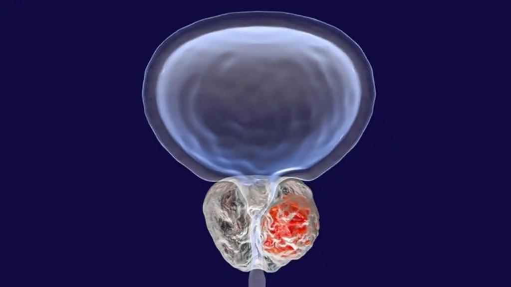 Ilustración de un cáncer de próstata.