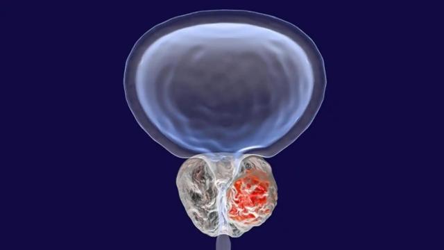 Ilustración de un cáncer de próstata.