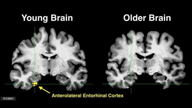 Escáneres cerebrales para determinar el rejuvenecimiento del cerebro,