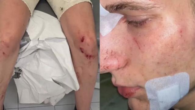 La víctima de la agresión ocurrida en Alginet muestra sus heridas.