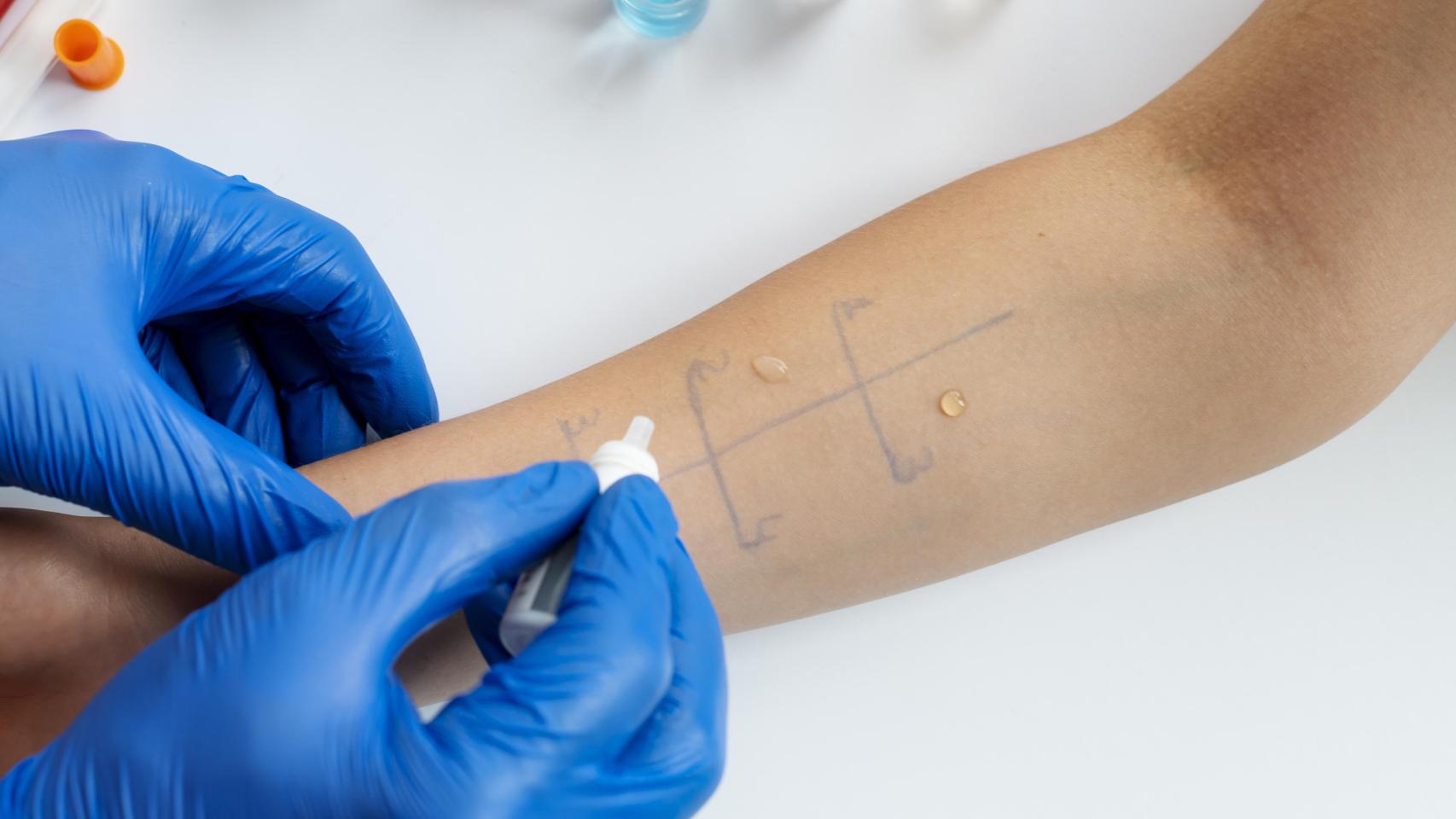 Reacción alérgica cutánea en el brazo de una persona.