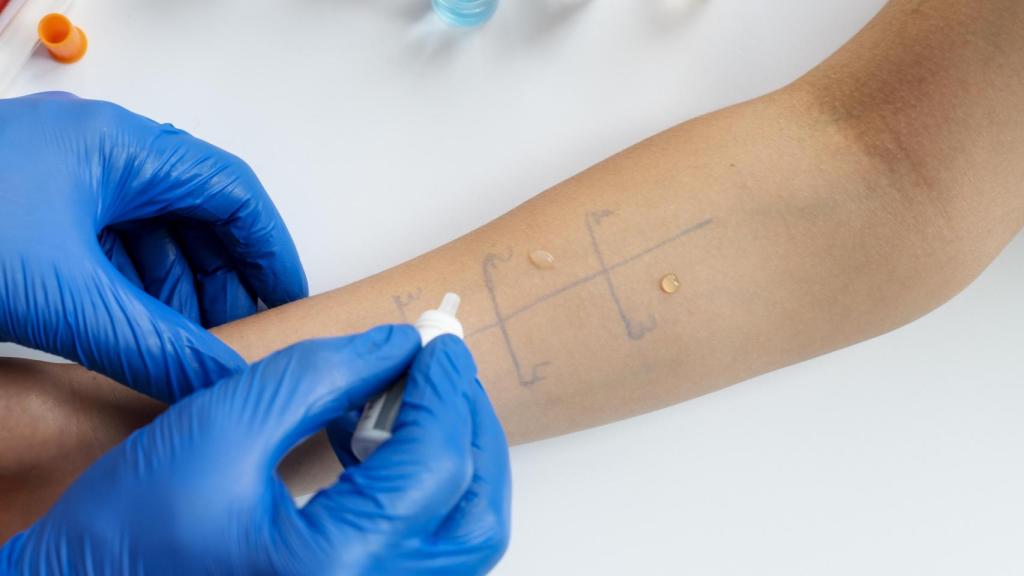 Reacción alérgica cutánea en el brazo de una persona.