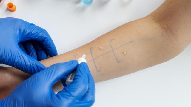 Reacción alérgica cutánea en el brazo de una persona.