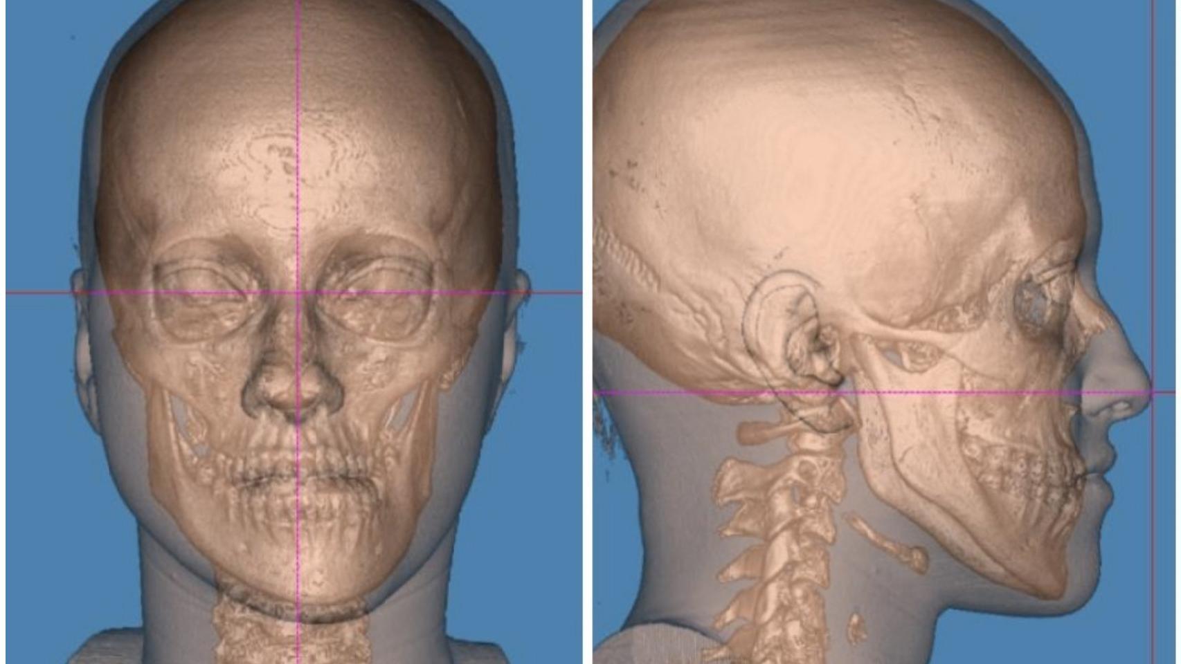 Estudio 3D de cirugía ortognática. Hospital Ruber Internacional.
