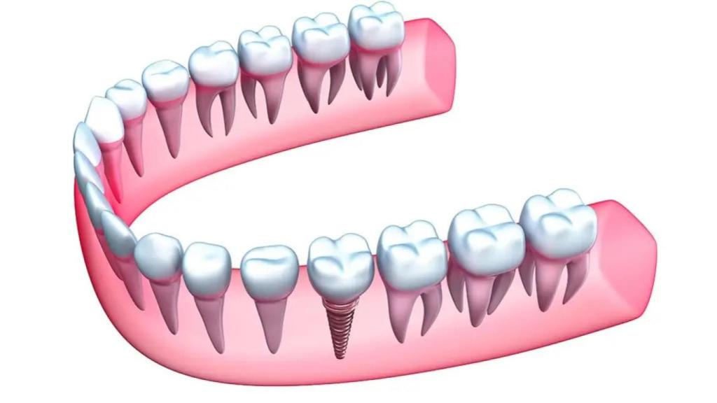 Implante dental.