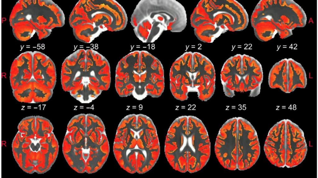 Imágenes del cerebro mostrando inflamación.