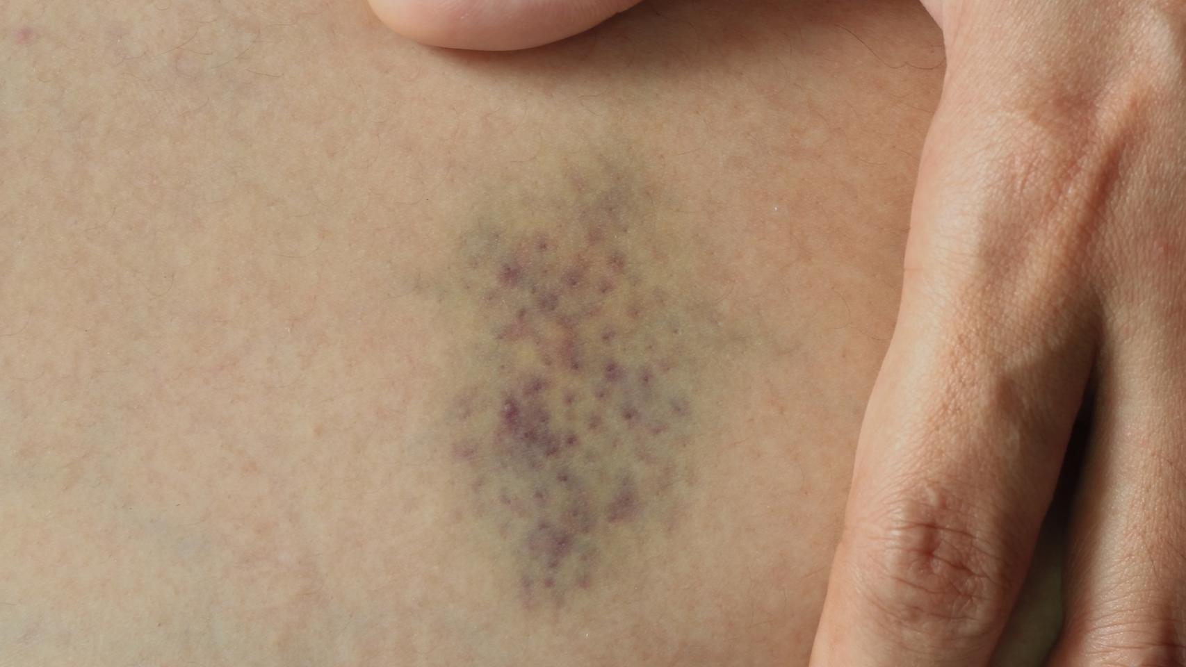 Hematoma (iStock)