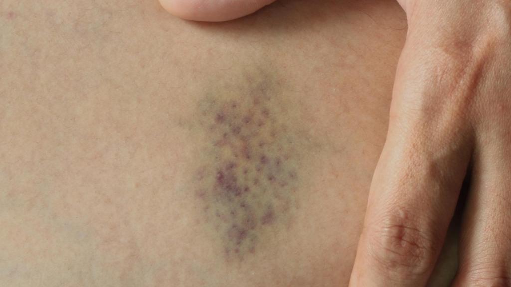 Hematoma (iStock)