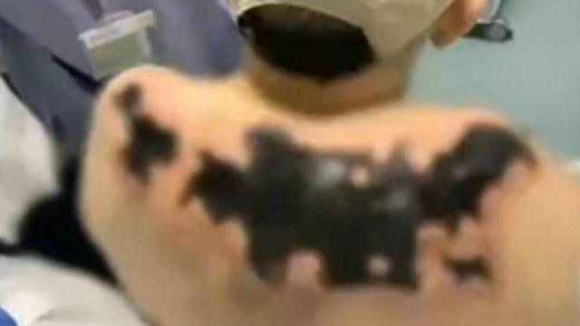 Imagen del anciano de 92 años con sus graves quemaduras