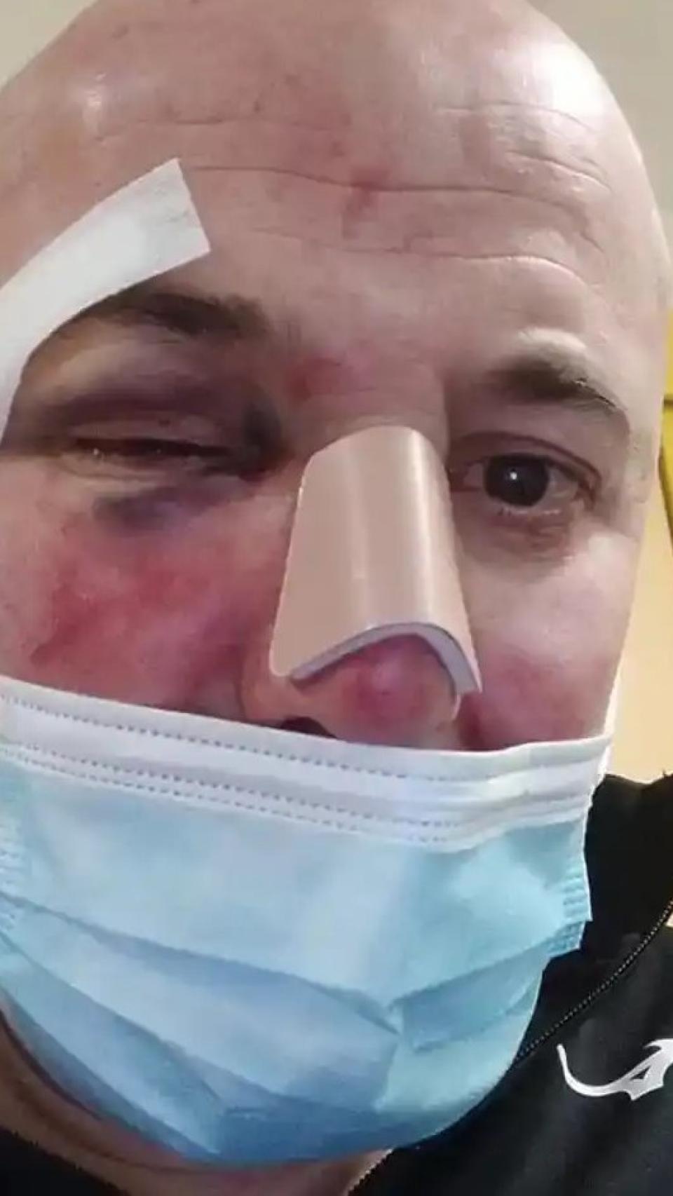 Una foto de Carlos con las lesiones que sufrió en la cara tras la paliza a manos supuestamente de dos policías nacionales.