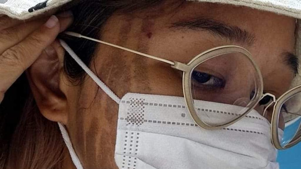 Issada Aisiri, presentadora que se sometió a un tratamiento.
