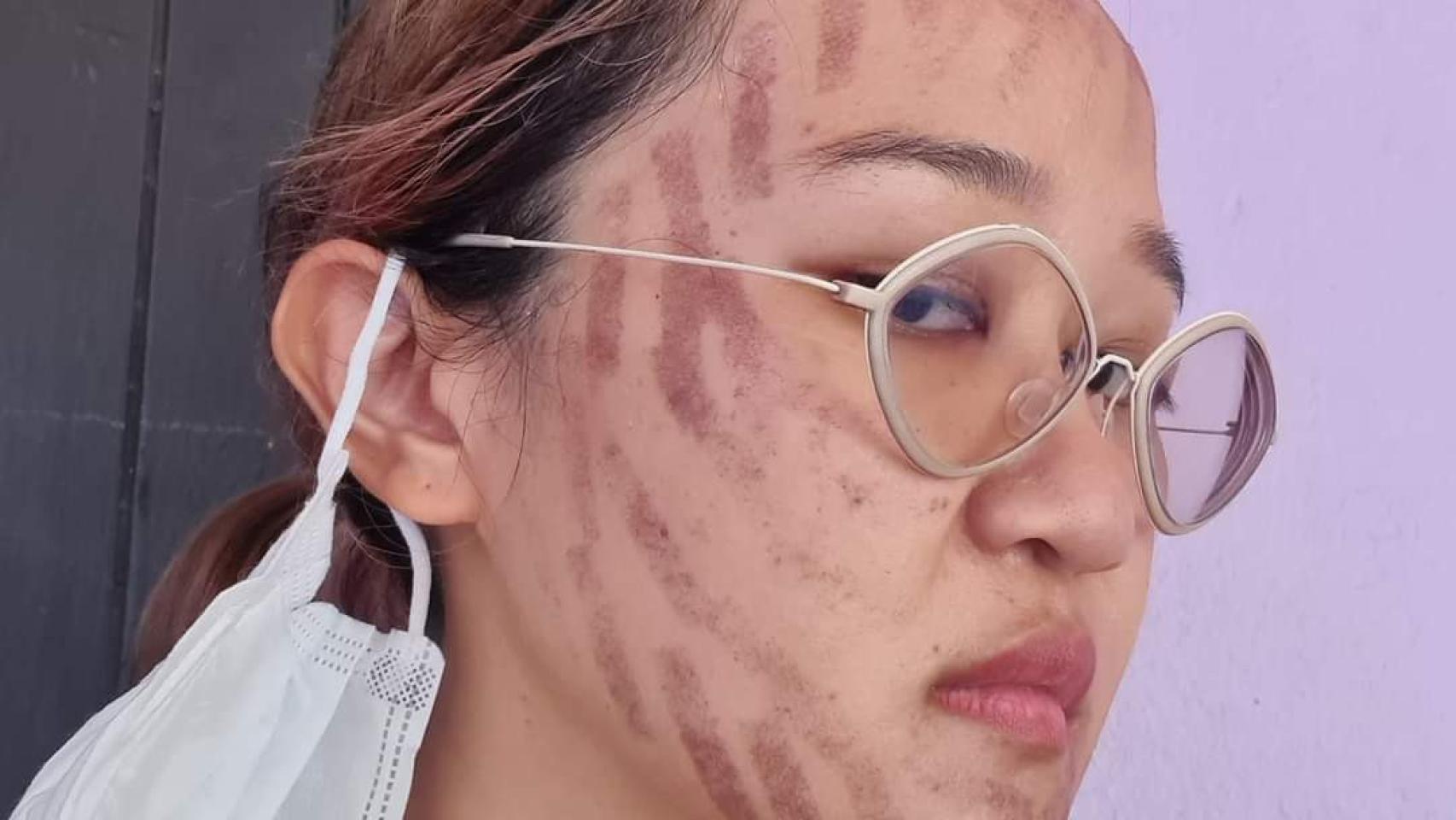 Issada Aisiri, la joven con secuelas en el tratamiento.