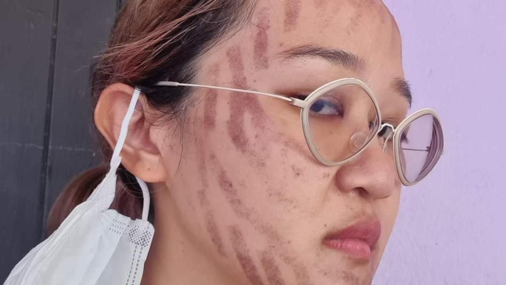 Issada Aisiri, la joven con secuelas en el tratamiento.