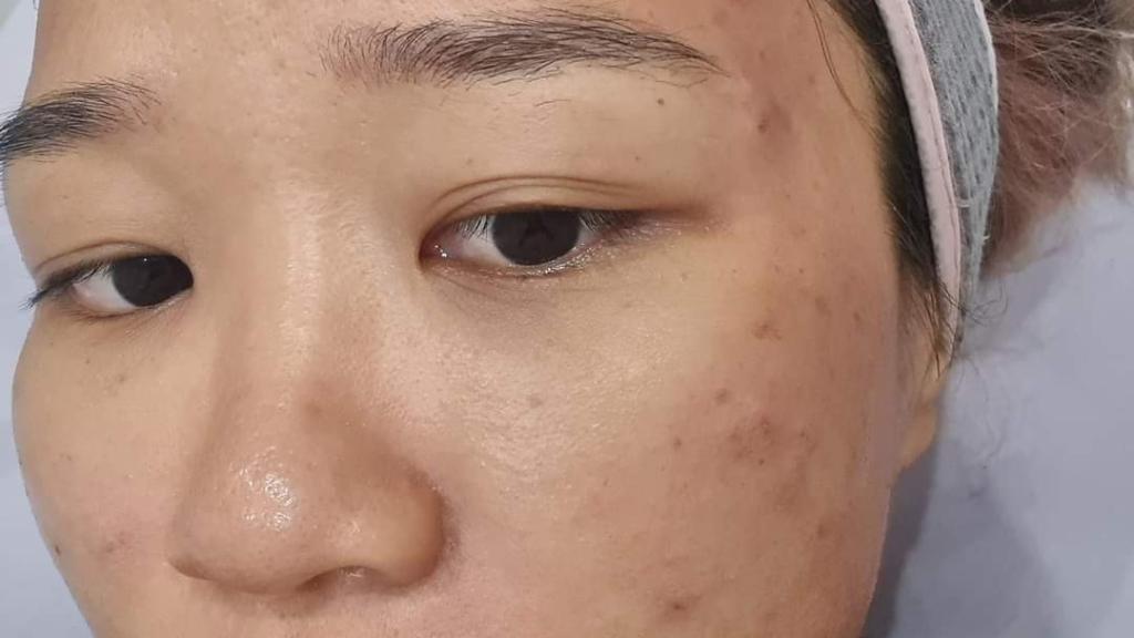 Issada Aisiri, en un tratamiento para las cicatrices.