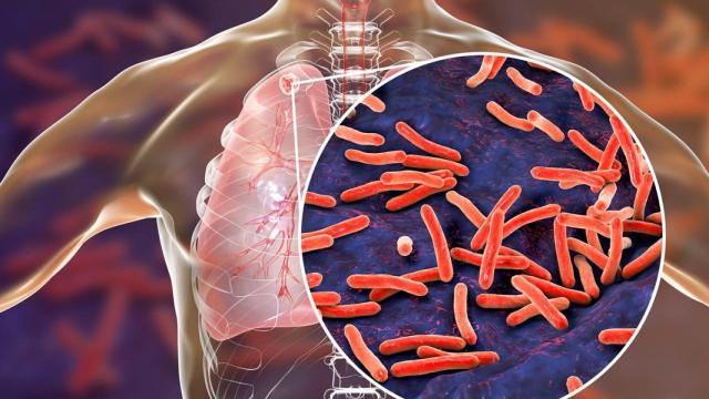 El cáncer de pulmón, último objetivo de la centenaria vacuna contra la tuberculosis