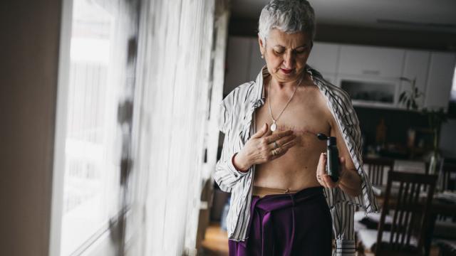 Imagen de archivo de una mujer tras una masectomía.