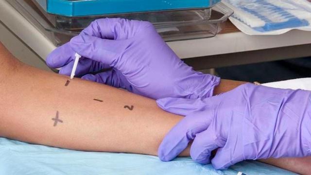 Un paciente se realiza una prueba de alergia.