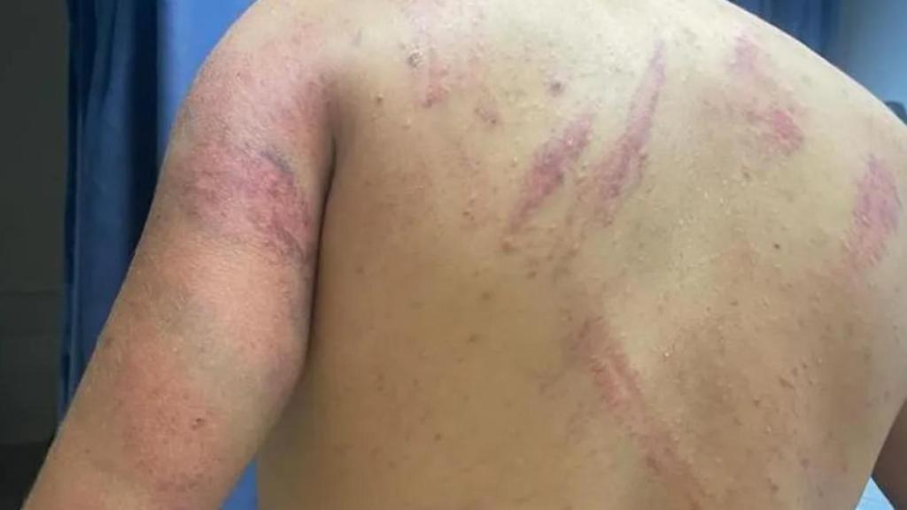 Heridas en la espalda de un hombre palestino