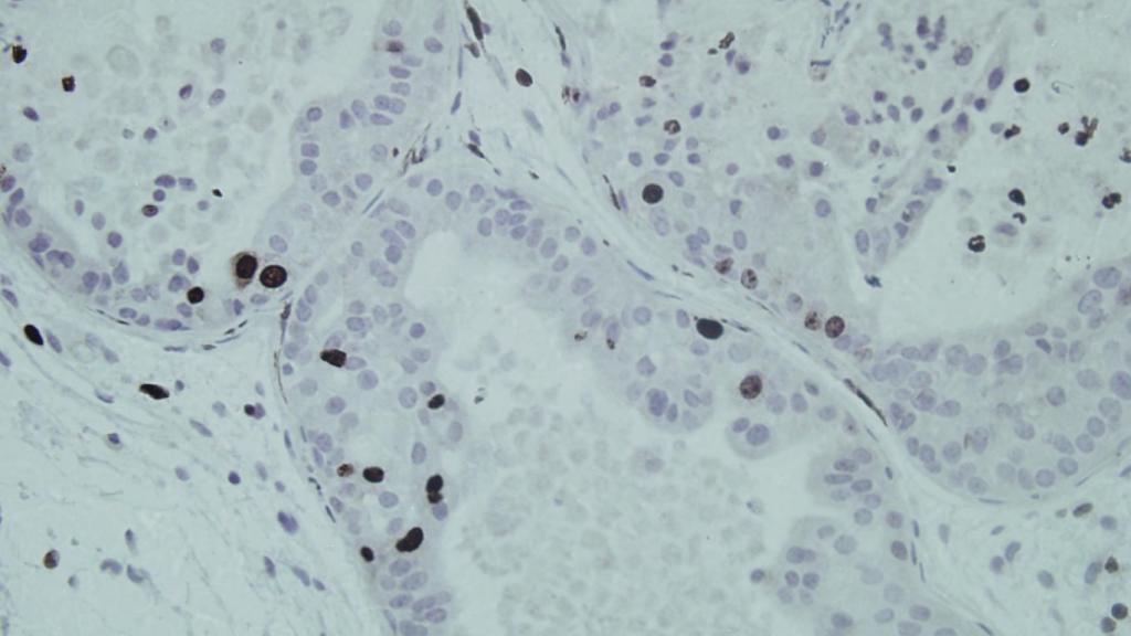 Cáncer de próstata