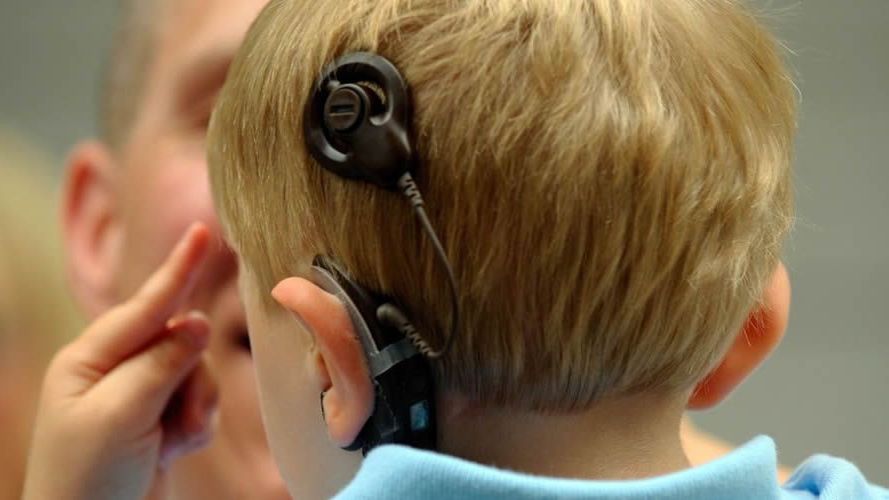 Implante coclear en un niño