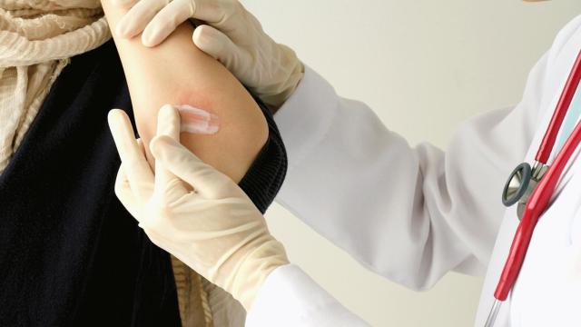 Psoriasis, una enfermedad que va más allá de la piel: así afecta a la salud mental