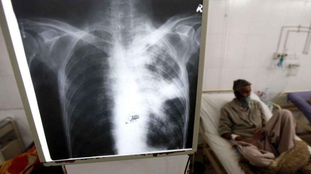 Desde el año 2021 los casos de tuberculosis en España no dejan de crecer.
