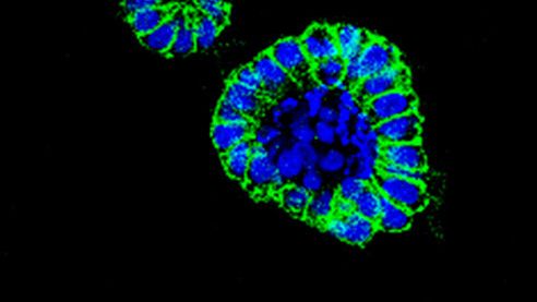 Organoide de cáncer de colon