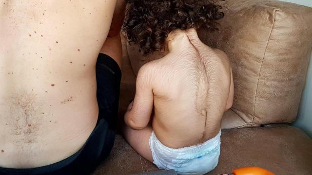 Uno de los niños afectados por el exceso de vello corporal. Defensor del Paciente