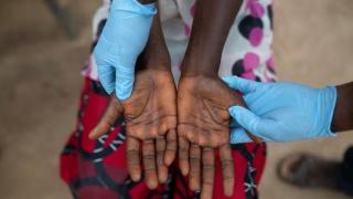 Lesiones en las manos de una paciente con Mpox.