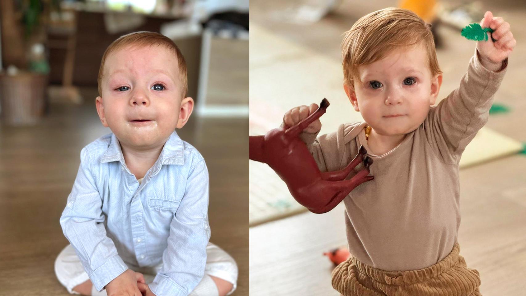 Un pequeño paciente del doctor Ramón Medel antes y después de la intervención.
