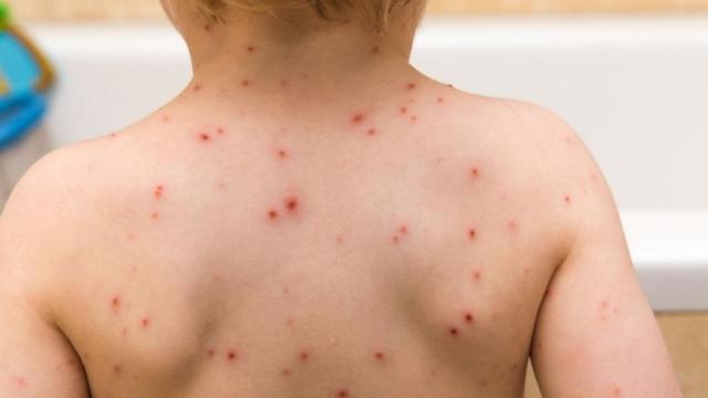 Un niño con varicela.