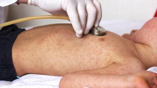 Un niño con sarampión.