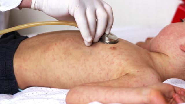 Un niño con sarampión.